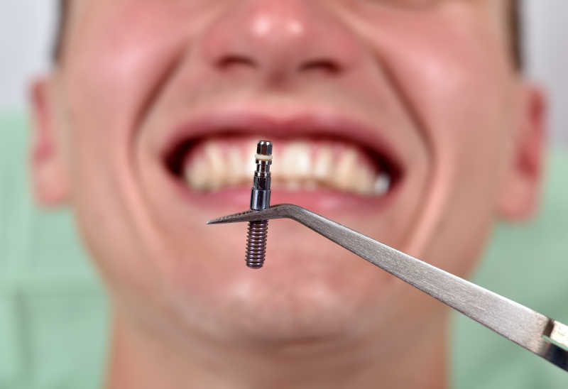 微笑患者背景下的牙种植体
