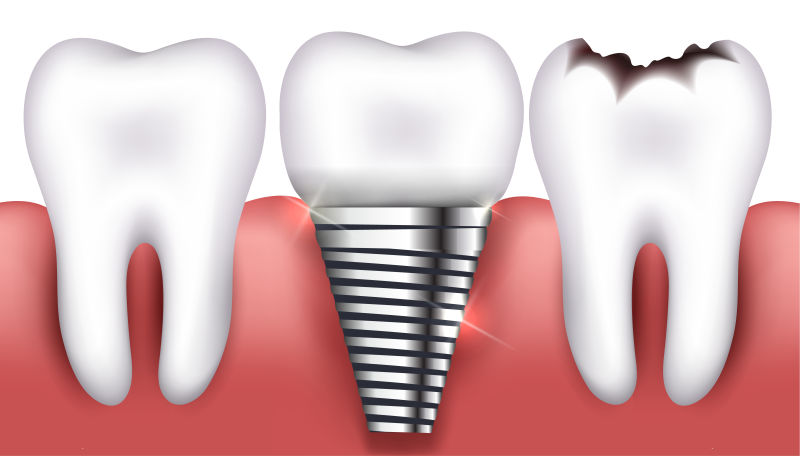 矢量牙齿和蛀齿和牙种植体