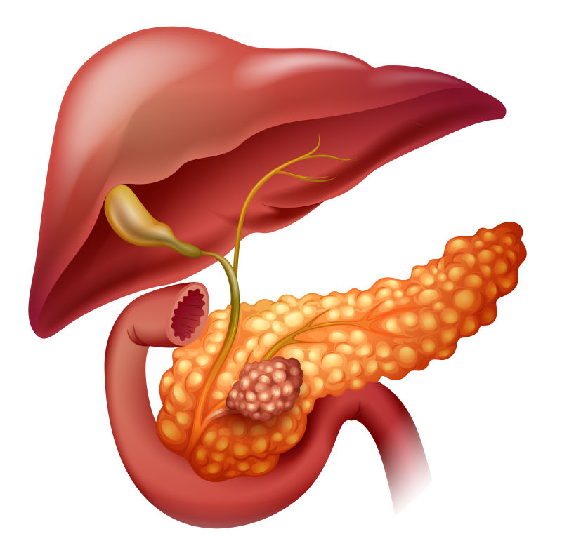 矢量胰腺癌图示插图