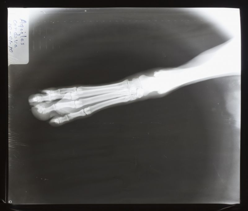 手掌骨骨骼x射线片子
