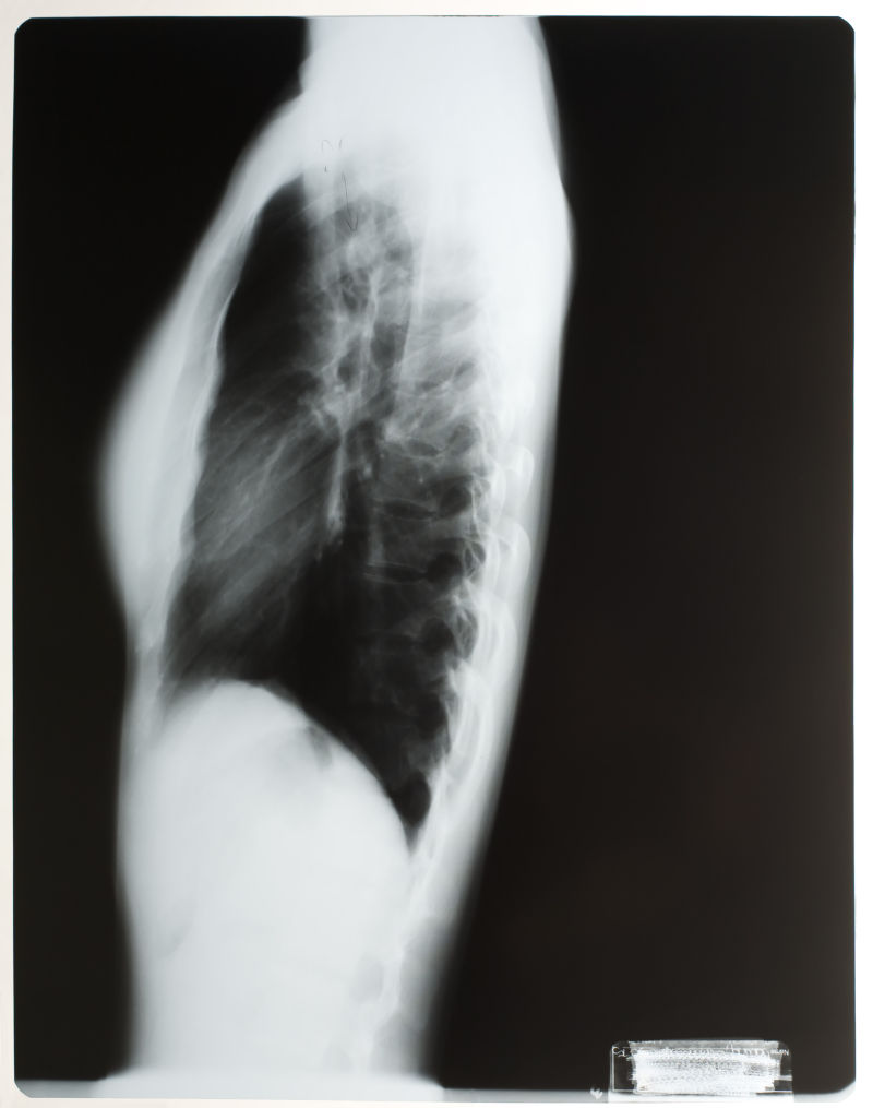 人体肺部侧面x射线片子
