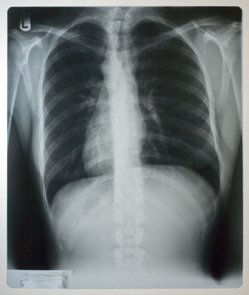 人体肺部胸透x射线片子