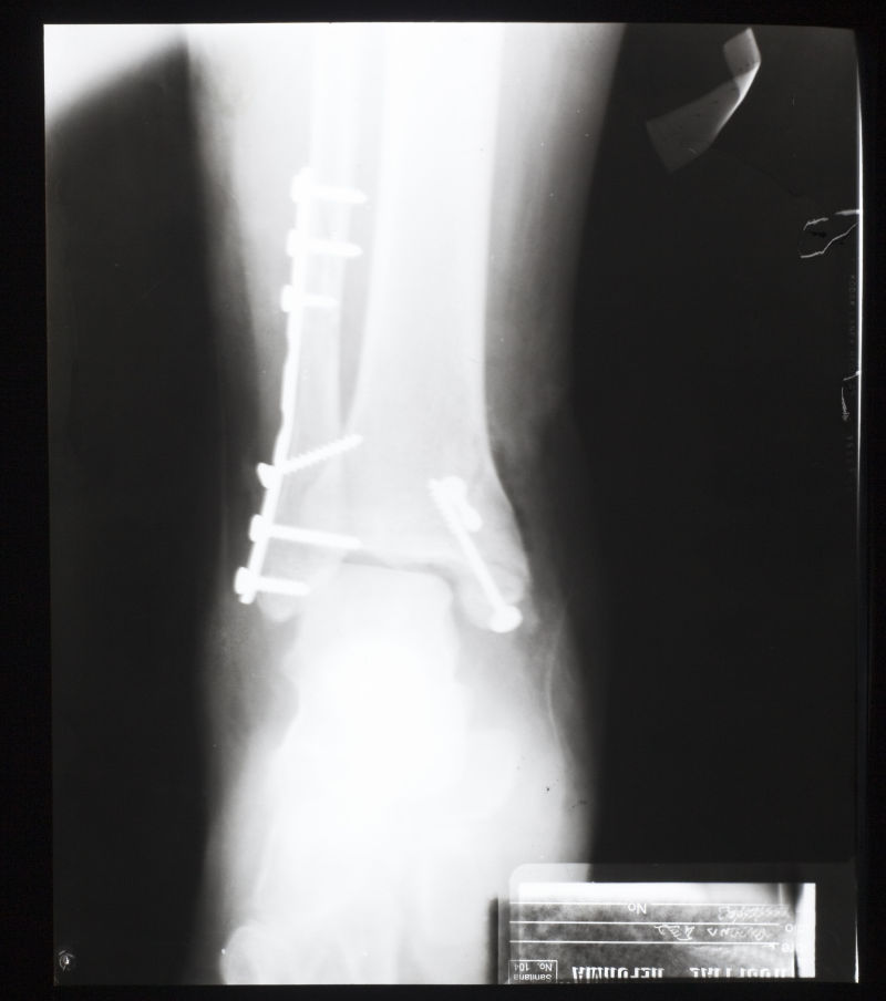 人体带钢钉的骨骼x射线片子