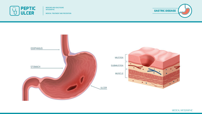 抽象矢量现代胃溃疡主题医疗信息插图设计